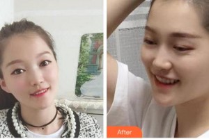 溫州醫(yī)科大學(xué)附屬口腔學(xué)院鄧輝整形價格表附金屬托槽矯正案例展示