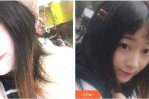 溫州醫(yī)科大學(xué)附屬口腔學(xué)院金向青整形價格表附金屬托槽矯正案例展示