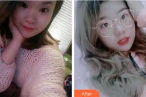 溫州醫(yī)科大學(xué)附屬口腔學(xué)院黃盛斌整形價格表附牙齒隱形矯正案例展示