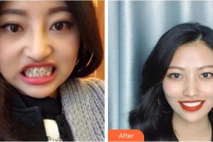 溫州醫(yī)科大學(xué)附屬口腔學(xué)院劉傳通整形價格表附牙齒陶瓷矯正案例展示