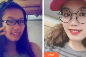 溫州醫(yī)科大學(xué)附屬口腔學(xué)院鄭敏玲整形價格表附隱形托槽矯正案例展示