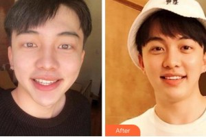 溫州醫(yī)科大學(xué)附屬口腔學(xué)院王劍鋒整形價格表附美白貼片案例展示