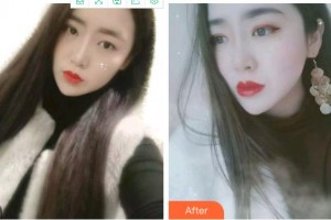 溫州醫(yī)科大學(xué)附屬口腔學(xué)院聶鑫整形價格表附金屬托槽矯正案例展示