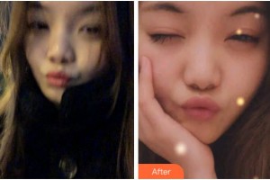 溫州醫(yī)科大學(xué)附屬口腔學(xué)院何奎芳整形價格表附牙齒隱形矯正案例展示