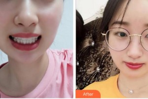 溫州醫(yī)科大學(xué)附屬口腔學(xué)院倪振宇整形價格表附牙齒隱形矯正案例展示