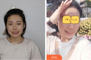 溫州醫(yī)科大學(xué)附屬口腔學(xué)院李鋒整形價格表附口腔矯正案例展示