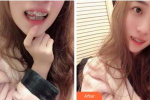 溫州醫(yī)科大學(xué)附屬口腔學(xué)院鄧振南整形價格表附金屬托槽矯正案例展示