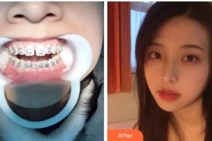 溫州醫(yī)科大學(xué)附屬口腔學(xué)院趙瑜整形價格表附隱形托槽矯正案例展示