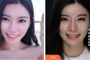 溫州醫(yī)科大學(xué)附屬口腔學(xué)院伊松整形價格表附美白貼片案例展示