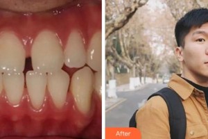 溫州醫(yī)科大學(xué)附屬口腔學(xué)院曹真勝整形價格表附金屬托槽矯正案例展示