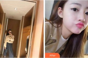 溫州王曉峰口腔醫(yī)院何輝整形價格表附牙齒隱形矯正案例展示