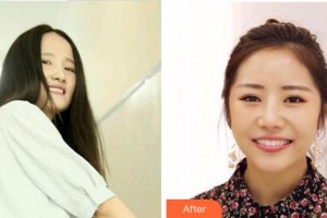 溫州王曉峰口腔醫(yī)院王潔瓊整形價格表附牙齒隱形矯正案例展示