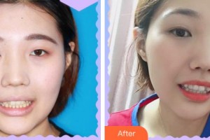 溫州王曉峰口腔醫(yī)院夏永微整形價格表附牙齒隱形矯正案例展示