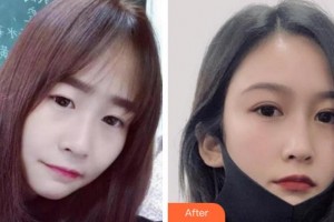 溫州明樂眼科醫(yī)院蔡迎暉整形價格表附切開雙眼皮案例展示