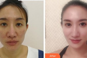 溫州明樂眼科醫(yī)院程鷺整形價格表附切開雙眼皮案例展示