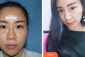 溫州明樂眼科醫(yī)院陳啟偉整形價格表附激光去眼袋案例展示