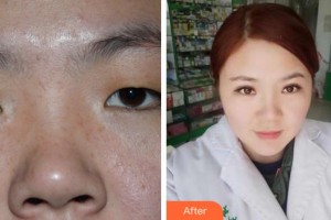 溫州醫(yī)科大學(xué)附屬眼視光醫(yī)院傅映暉整形價格表附眼部綜合案例展示