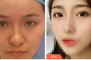 溫州醫(yī)科大學(xué)附屬眼視光醫(yī)院李軍花整形價格表附切開雙眼皮案例展示