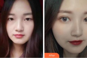 溫州醫(yī)科大學(xué)附屬眼視光醫(yī)院侯立杰整形價格表附切開雙眼皮案例展示