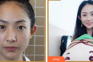 溫州醫(yī)科大學(xué)附屬眼視光醫(yī)院張赟整形價格表附眼部綜合案例展示