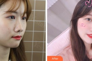 溫州醫(yī)科大學(xué)附屬眼視光醫(yī)院常平駿整形價格表附眼部整形案例展示