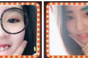 溫州醫(yī)科大學(xué)附屬眼視光醫(yī)院傅亞娜整形價格表附牙齒陶瓷矯正案例展示