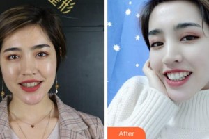 溫州拜博口腔醫(yī)院郭軍鋒整形價格表附牙貼面案例展示