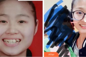 溫州藍芽口腔門診部趙微整形價格表附金屬托槽矯正案例展示