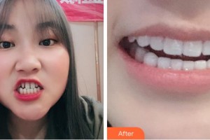 溫州牙博士口腔門診部劉名燕整形價格表附牙貼面案例展示