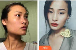 嘉興市曙光中西醫(yī)結(jié)合醫(yī)院整形美容科高峻整形價格表附切開雙眼皮案例展示