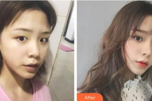 嘉興華山醫(yī)療美容醫(yī)院傘光整形價格表附切開雙眼皮案例展示