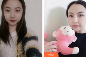 嘉興華山醫(yī)療美容醫(yī)院李紅波整形價格表附切開雙眼皮案例展示