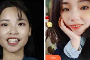 嘉興市曙光中西醫(yī)結(jié)合醫(yī)院整形美容科趙艷整形價格表附金屬托槽矯正案例展示