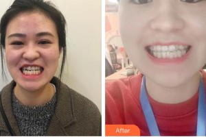 嘉興市曙光中西醫(yī)結(jié)合醫(yī)院整形美容科趙云整形價格表附牙齒隱形矯正案例展示