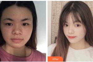 嘉興禾美醫(yī)療美容醫(yī)院梁海元整形價(jià)格表附埋線提升案例展示