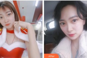 嘉興愛爾眼科醫(yī)院趙春會整形價(jià)格表附切開雙眼皮案例展示