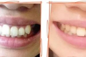 嘉興口腔醫(yī)院曾聰整形價(jià)格表附牙齒隱形矯正案例展示