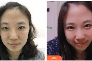 嘉興市中醫(yī)醫(yī)院眼科翁文慶整形價(jià)格表附眼部綜合案例展示