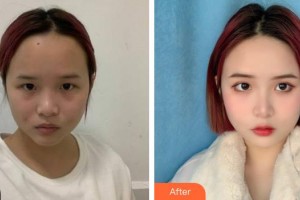 湖州曙光醫(yī)療美容門診部蘇恭敏整形價格表附激光祛斑案例展示