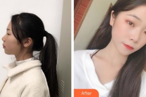 湖州曙光醫(yī)療美容門診部李倩整形價格表附美白嫩膚案例展示