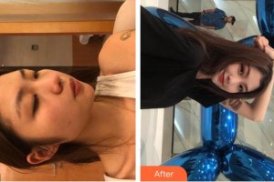 湖州同濟醫(yī)療美容門診部周敏珍整形價格表附光子嫩膚案例展示