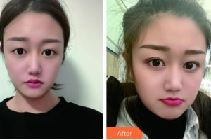 湖州心悅醫(yī)療美容門診部聶益軍整形價格表附埋線雙眼皮案例展示