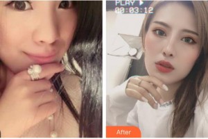 湖州長興愛爾眼科醫(yī)院童峰峰整形價格表附眼部綜合案例展示