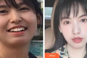 湖州金鉑利口腔門診部郭振中整形價格表附金屬托槽矯正案例展示