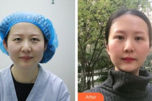 湖州星范林華醫(yī)療美容診所陳武林整形價格表附切開雙眼皮案例展示