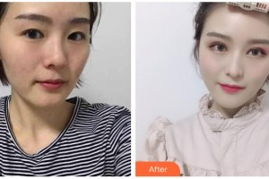 湖州愛爾眼科醫(yī)院褚任遠整形價格表附切開雙眼皮案例展示