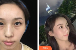 湖州愛爾眼科醫(yī)院吳元奇整形價格表附激光去黑眼圈案例展示