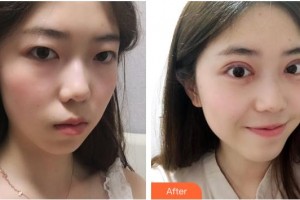 湖州愛爾眼科醫(yī)院俞臻整形價格表附開內眼角案例展示