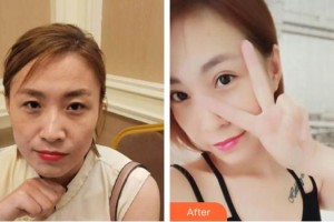 湖州愛爾眼科醫(yī)院唐劍波整形價格表附眼部綜合案例展示