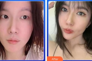 湖州愛爾眼科醫(yī)院閔偉峰整形價格表附眼部綜合案例展示